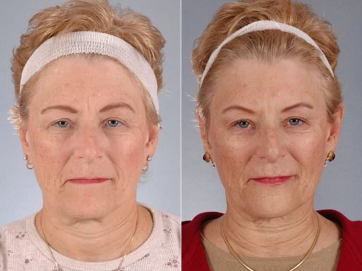 WNatural Micromidfacelift™ Before & After Gallery - Patient 119764 - Image 1