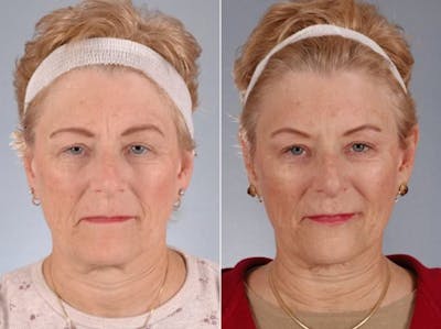 WNatural Micromidfacelift™ Before & After Gallery - Patient 119764 - Image 1
