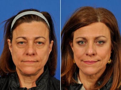 WNatural Micromidfacelift™ Before & After Gallery - Patient 728711 - Image 1