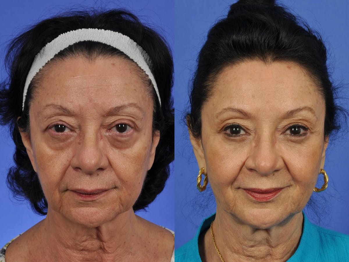WNatural Micromidfacelift™ Before & After Gallery - Patient 777760 - Image 1