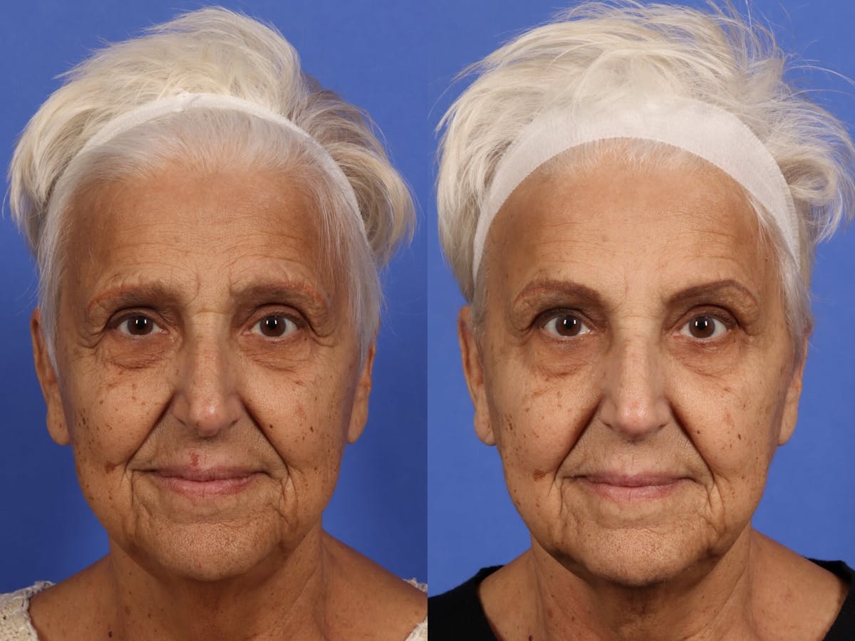 BOTOX® Before & After Gallery - Patient 295526 - Image 1