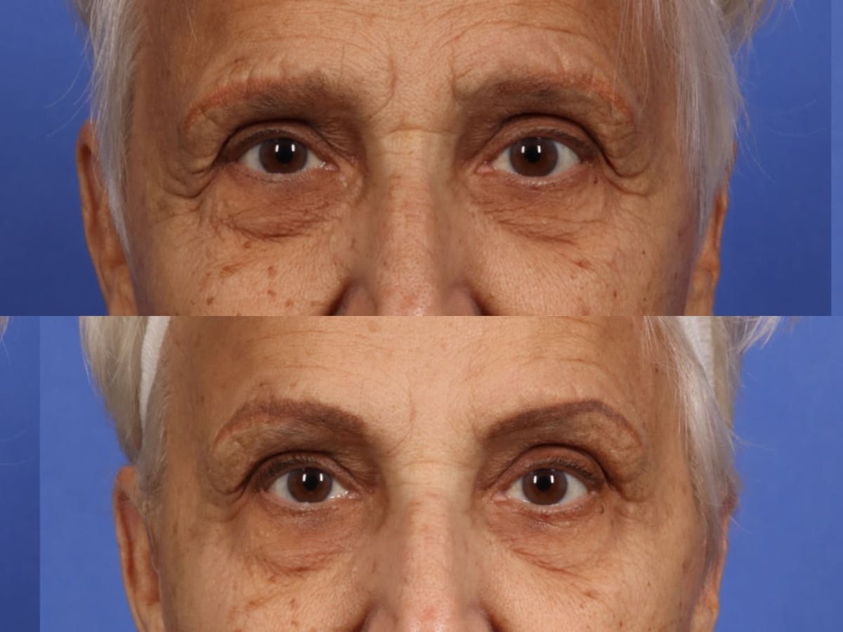 BOTOX® Before & After Gallery - Patient 295526 - Image 2