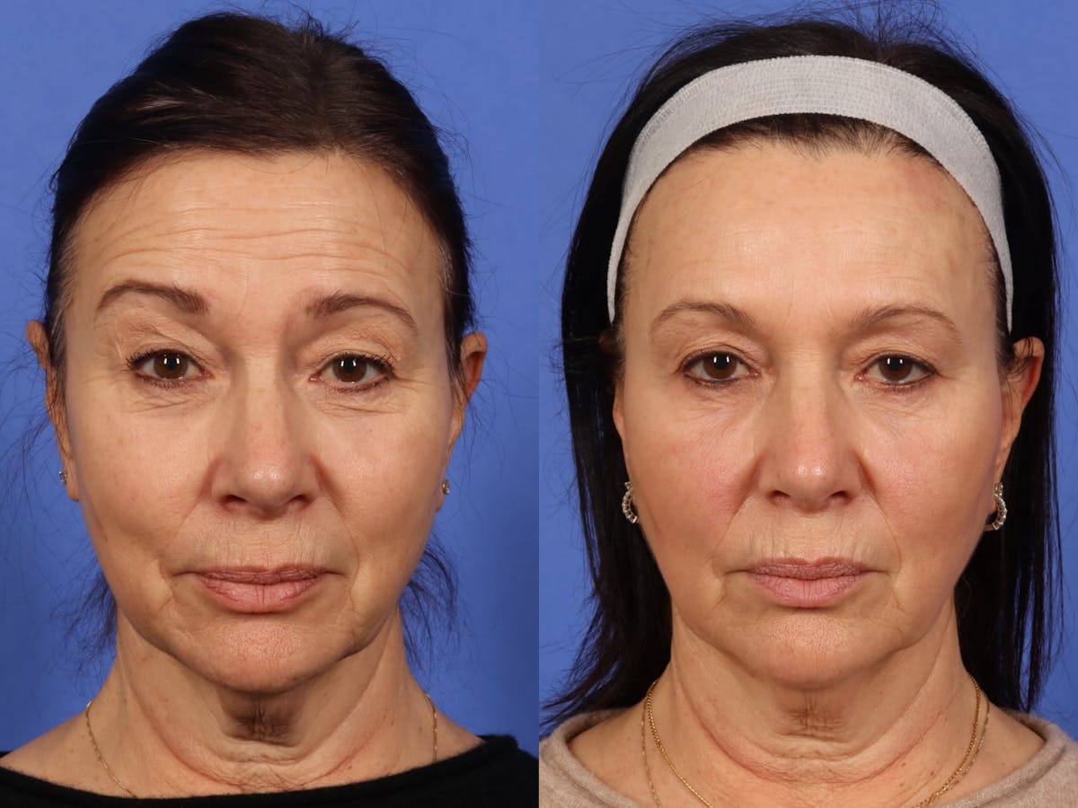 BOTOX® Before & After Gallery - Patient 169221 - Image 1