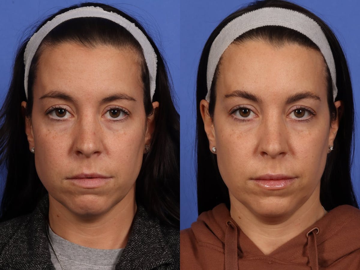 BOTOX® Before & After Gallery - Patient 417997 - Image 1