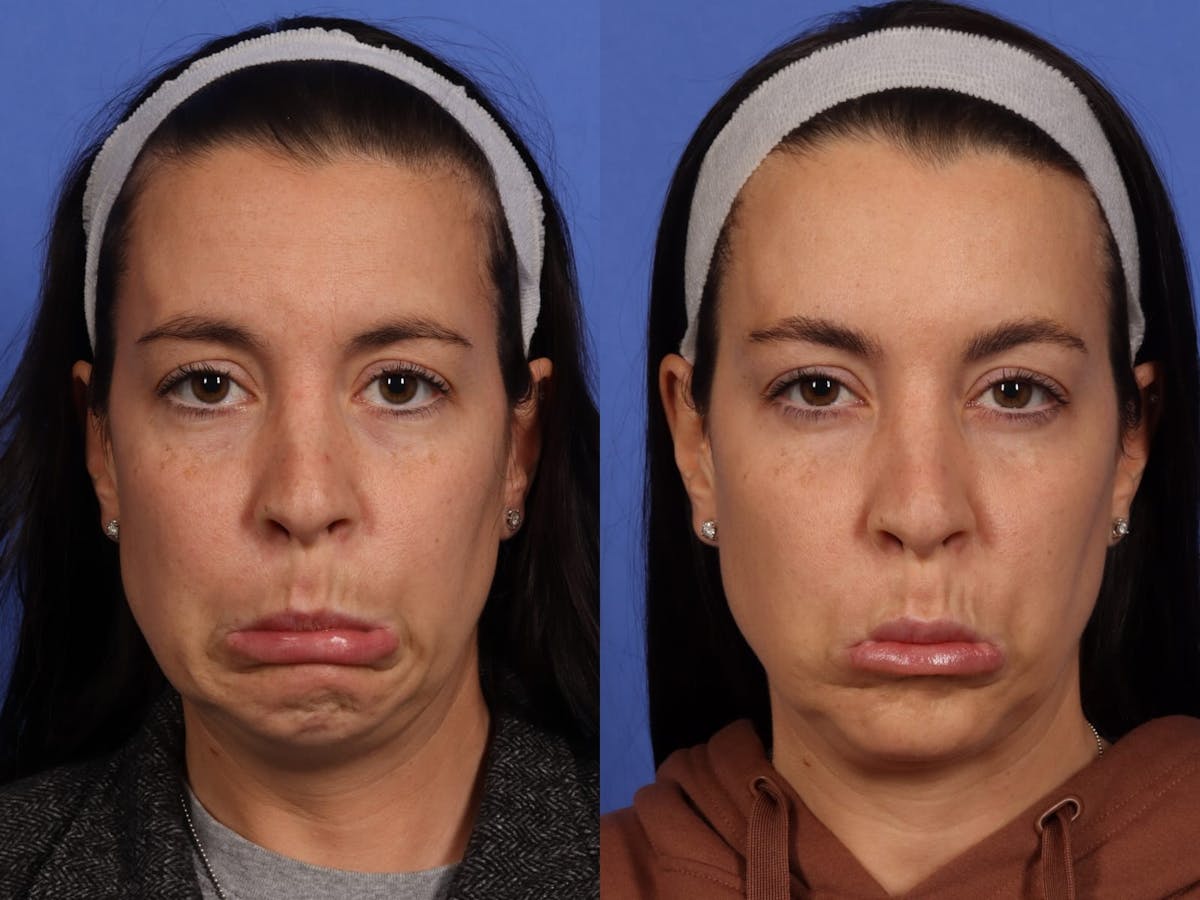 BOTOX® Before & After Gallery - Patient 417997 - Image 2
