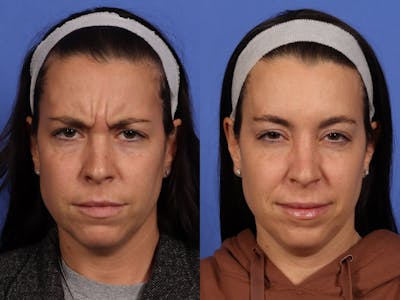 BOTOX® Before & After Gallery - Patient 417997 - Image 3