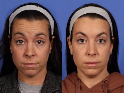 BOTOX® Before & After Gallery - Patient 417997 - Image 4