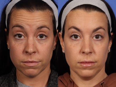 BOTOX® Before & After Gallery - Patient 417997 - Image 5