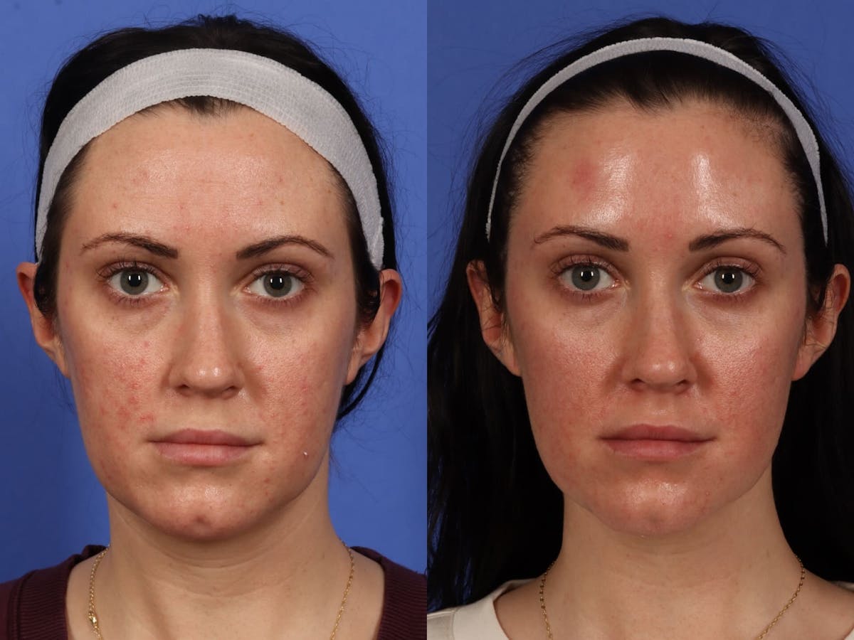 BOTOX® Before & After Gallery - Patient 394495 - Image 1