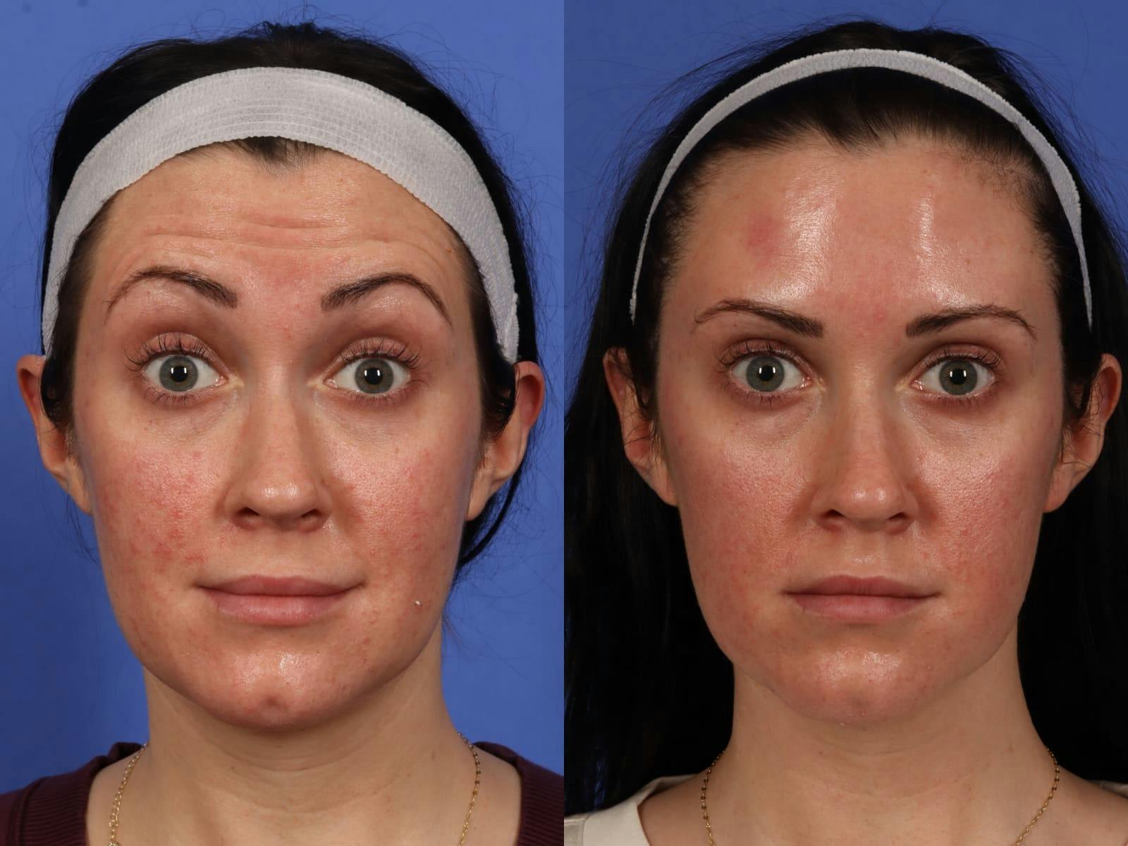 BOTOX® Before & After Gallery - Patient 394495 - Image 2