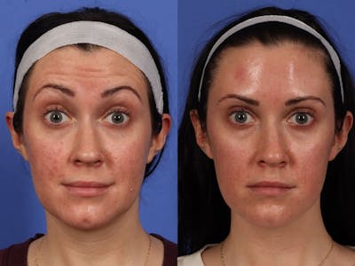 BOTOX® Before & After Gallery - Patient 394495 - Image 2
