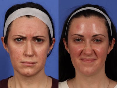 BOTOX® Before & After Gallery - Patient 394495 - Image 3