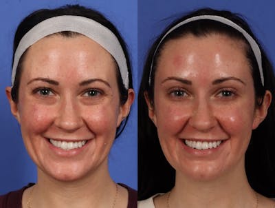 BOTOX® Before & After Gallery - Patient 394495 - Image 4