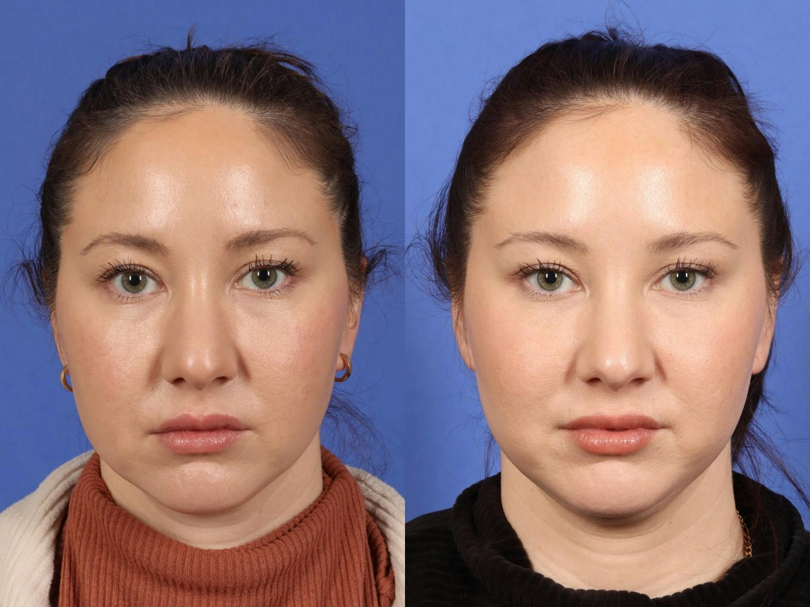 BOTOX® Before & After Gallery - Patient 130840 - Image 1