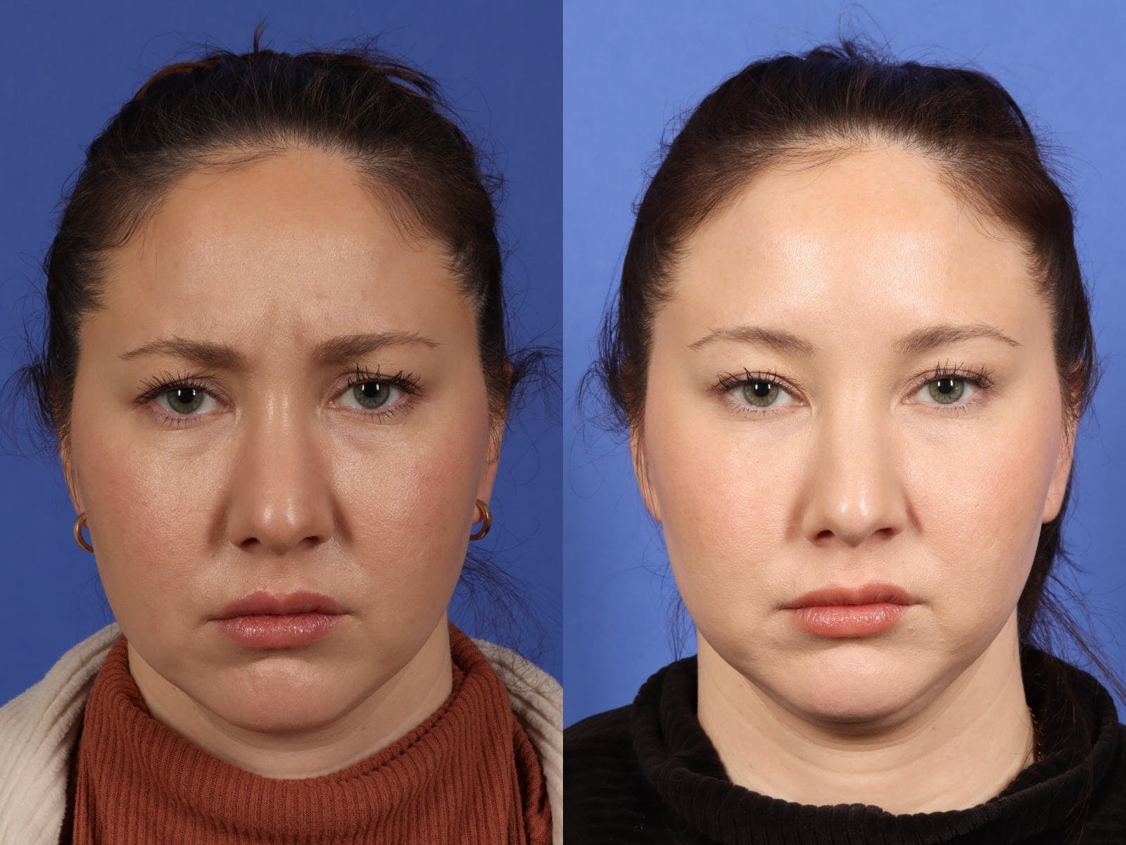 BOTOX® Before & After Gallery - Patient 130840 - Image 2