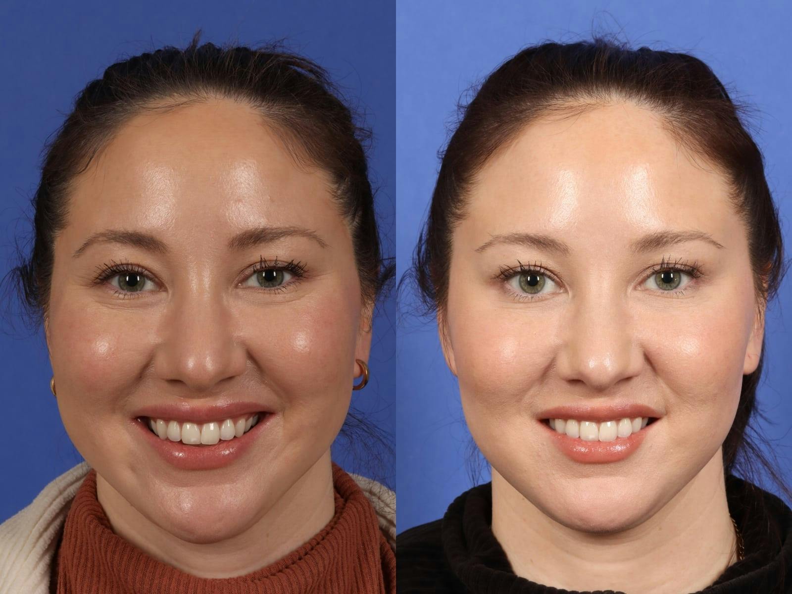BOTOX® Before & After Gallery - Patient 130840 - Image 3