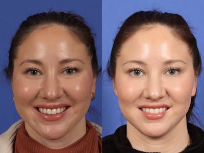 BOTOX® Before & After Gallery - Patient 130840 - Image 3
