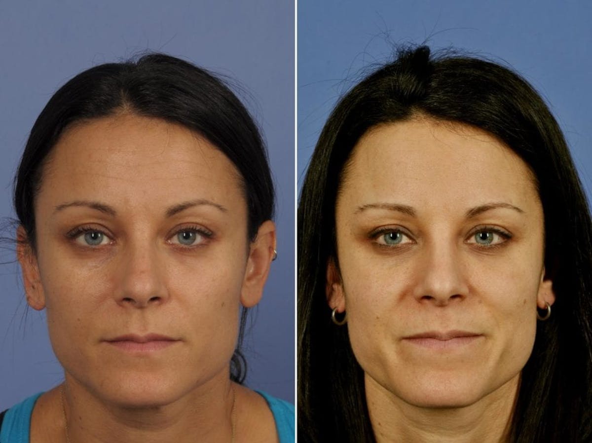 BOTOX® Before & After Gallery - Patient 136470 - Image 1