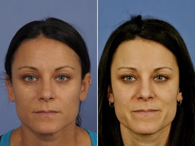 BOTOX® Before & After Gallery - Patient 136470 - Image 1