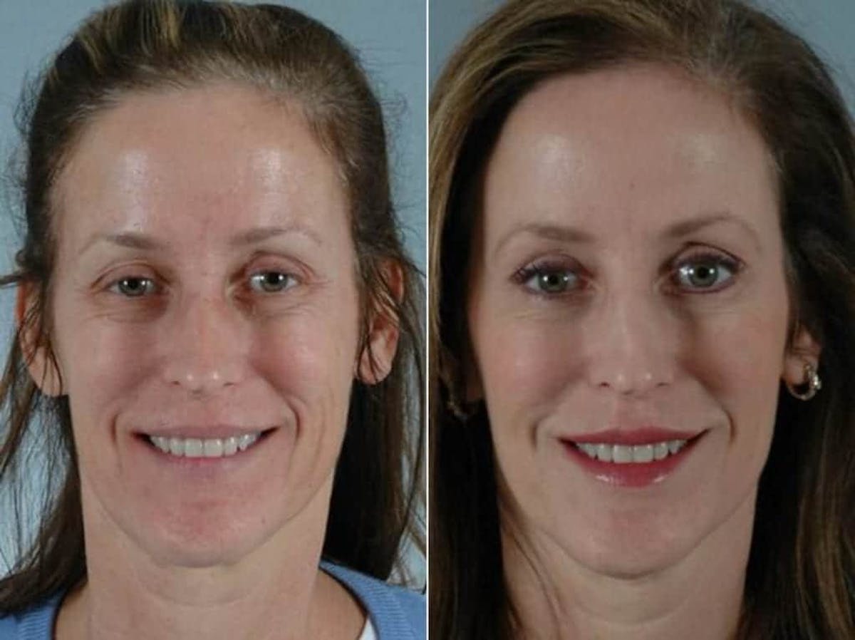 BOTOX® Before & After Gallery - Patient 255887 - Image 1