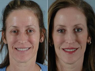 BOTOX® Before & After Gallery - Patient 255887 - Image 1