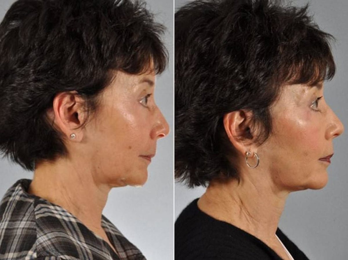 BOTOX® Before & After Gallery - Patient 119969 - Image 1