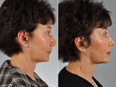 BOTOX® Before & After Gallery - Patient 119969 - Image 1