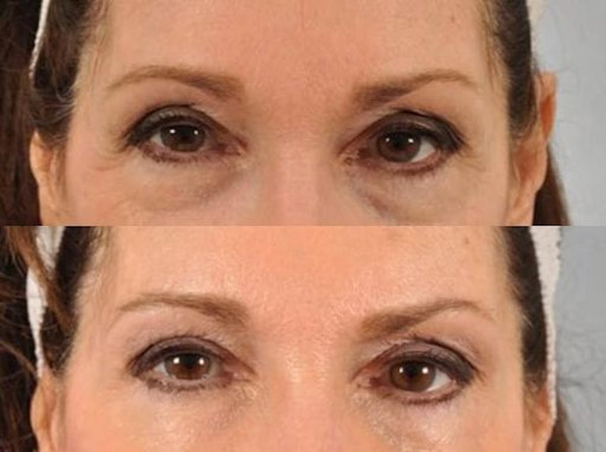 BOTOX® Before & After Gallery - Patient 518659 - Image 1