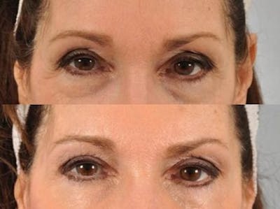 BOTOX® Before & After Gallery - Patient 518659 - Image 1