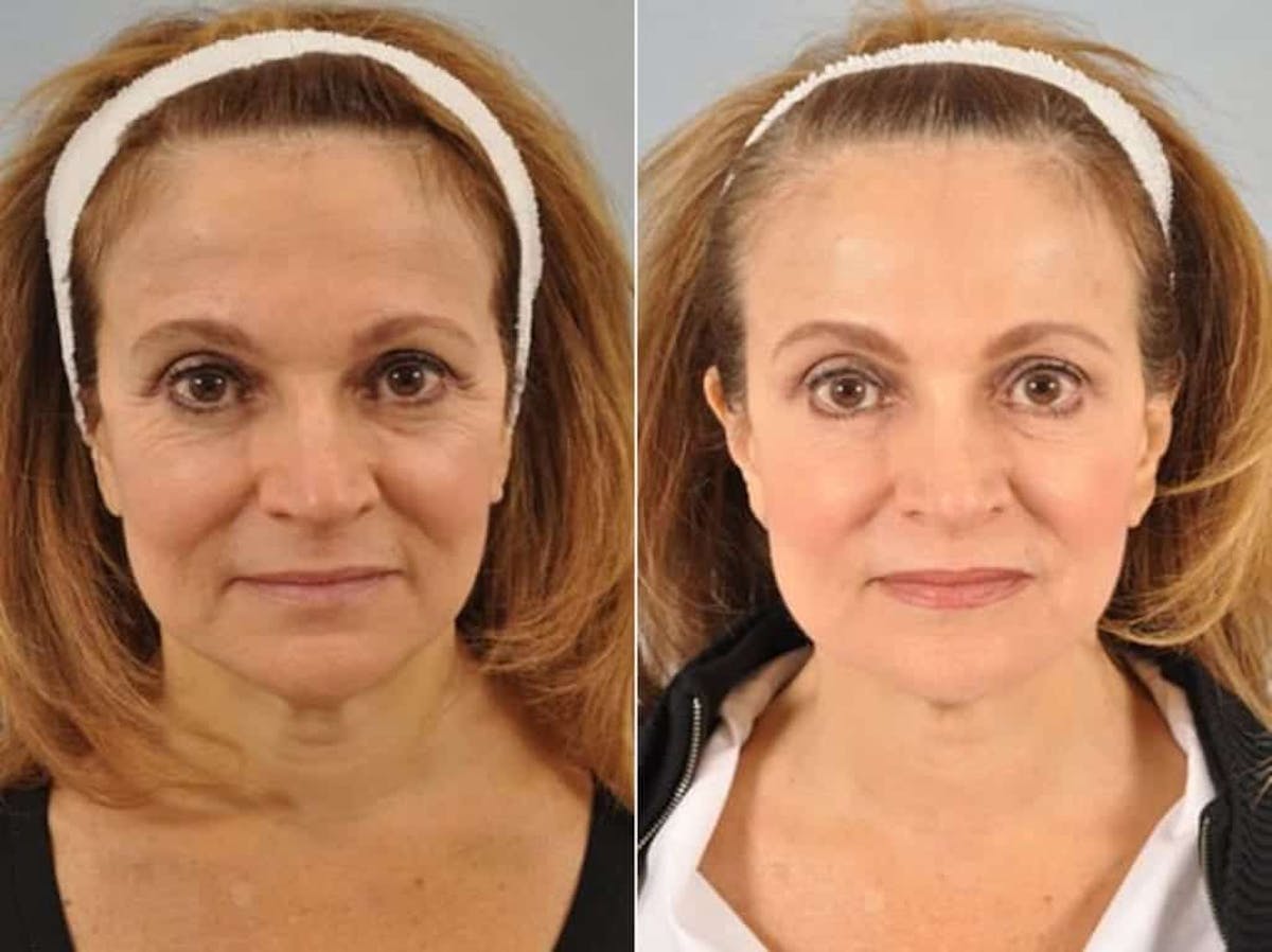 BOTOX® Before & After Gallery - Patient 423367 - Image 1