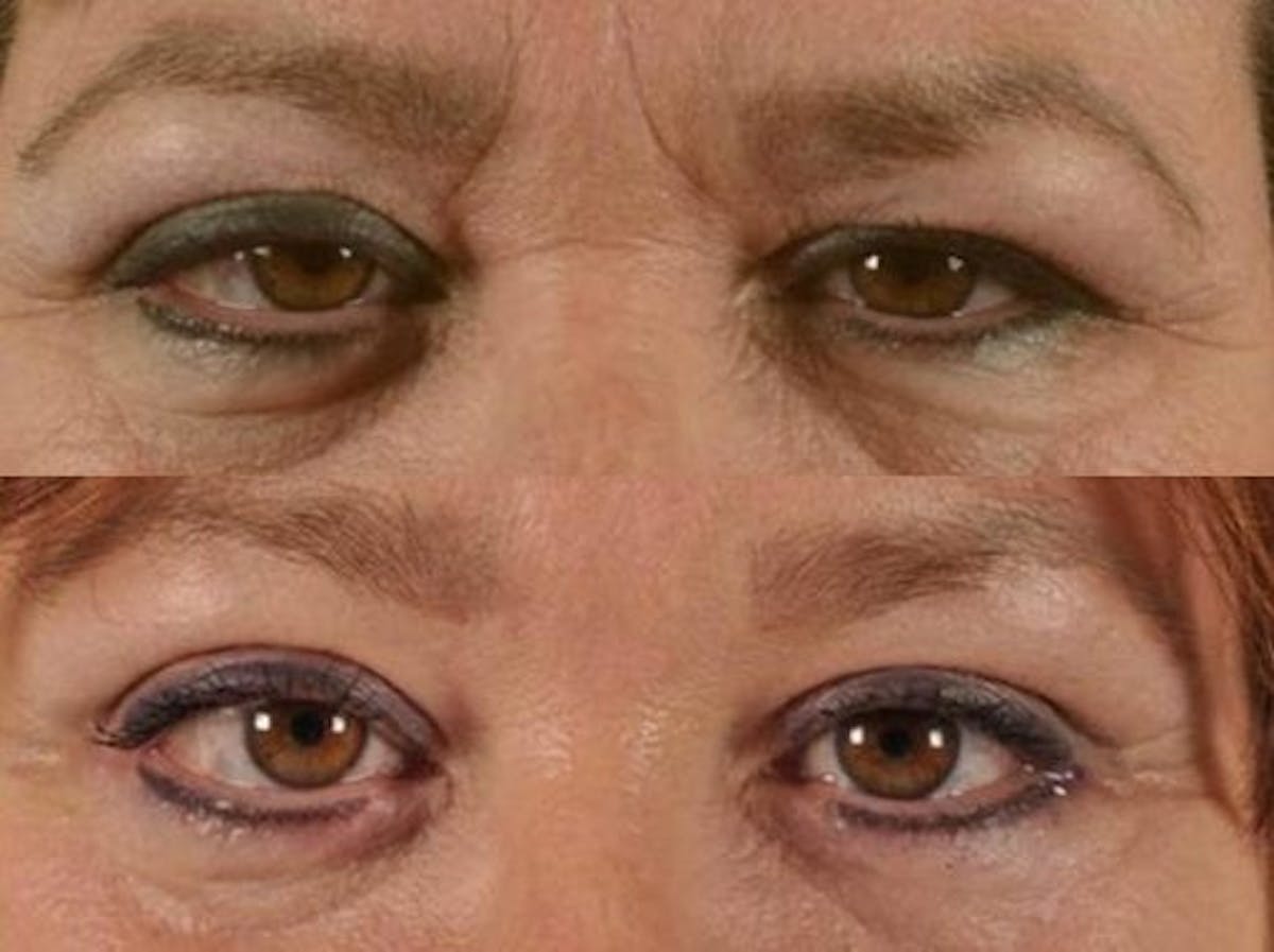 BOTOX® Before & After Gallery - Patient 856755 - Image 1