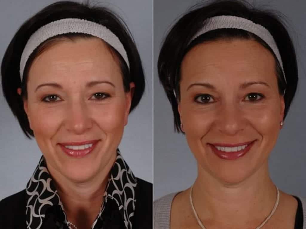 BOTOX® Before & After Gallery - Patient 395701 - Image 1