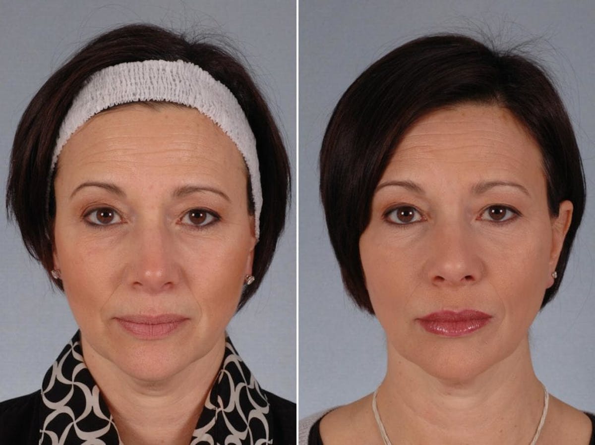 BOTOX® Before & After Gallery - Patient 395701 - Image 2