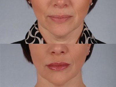 BOTOX® Before & After Gallery - Patient 395701 - Image 3