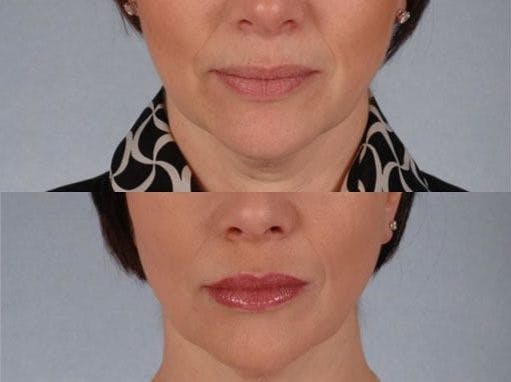 BOTOX® Before & After Gallery - Patient 395701 - Image 3