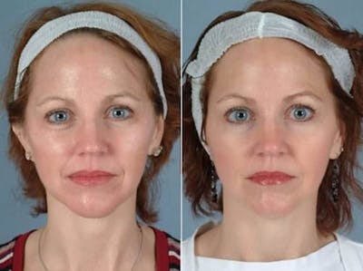 BOTOX® Before & After Gallery - Patient 109394 - Image 1