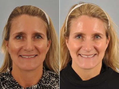 BOTOX® Before & After Gallery - Patient 104997 - Image 1
