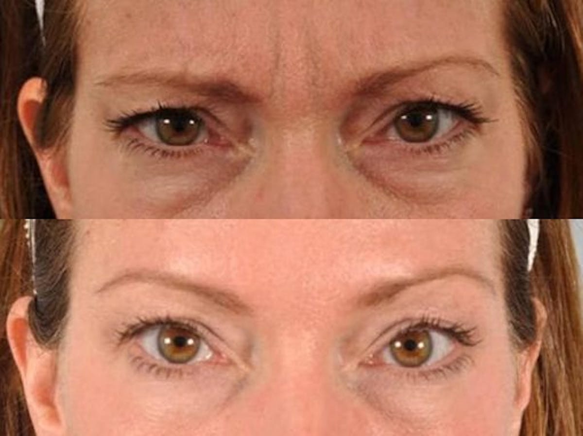 BOTOX® Before & After Gallery - Patient 395630 - Image 1