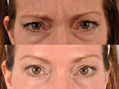 BOTOX® Before & After Gallery - Patient 395630 - Image 1