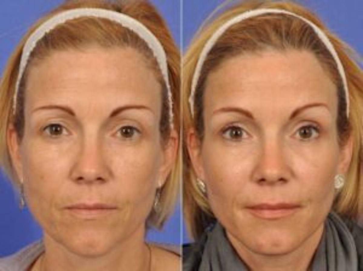 BOTOX® Before & After Gallery - Patient 912364 - Image 1