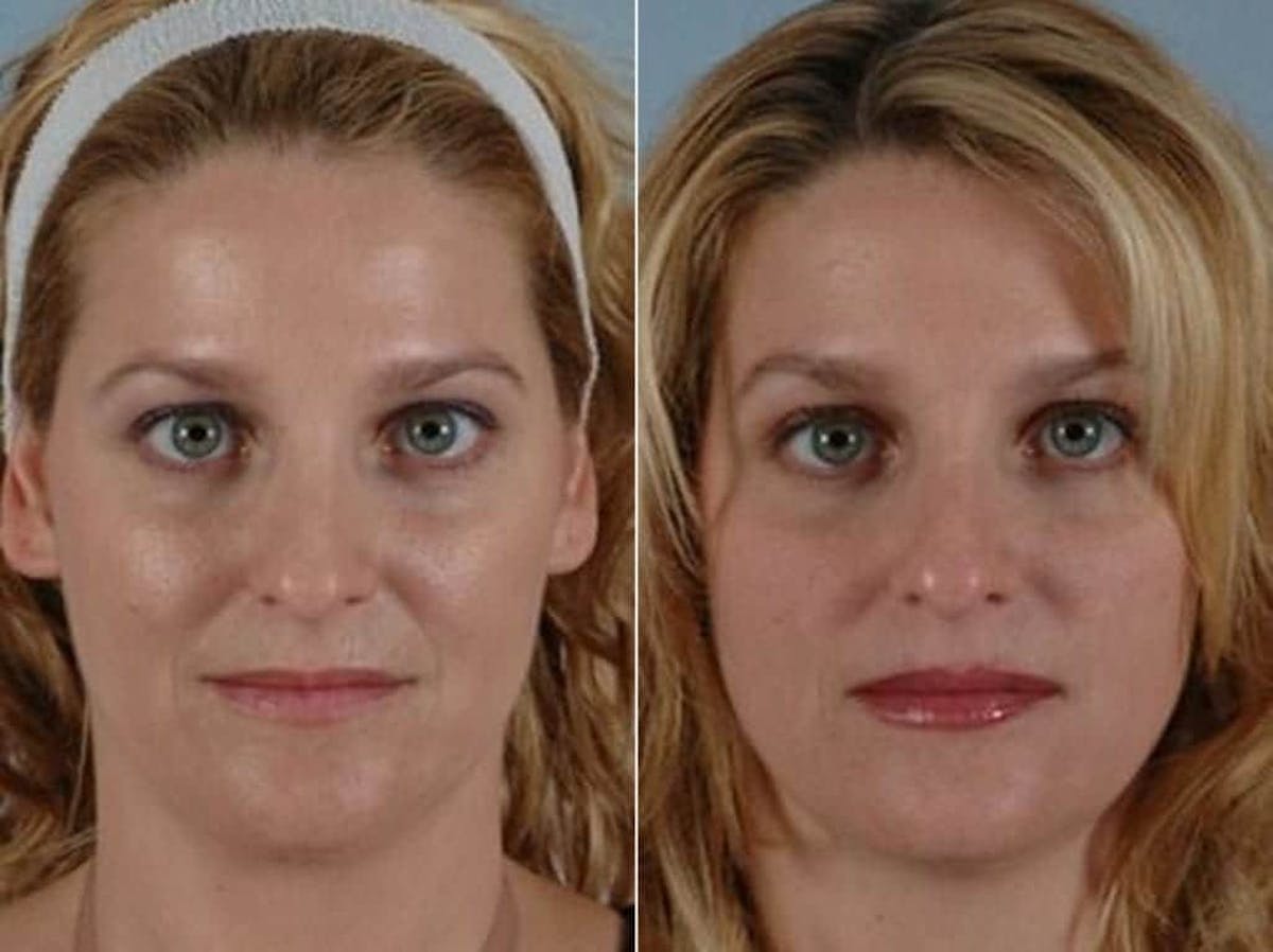 BOTOX® Before & After Gallery - Patient 186929 - Image 1