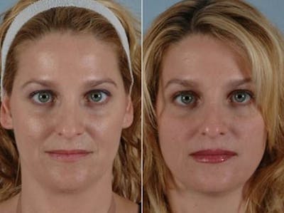 BOTOX® Before & After Gallery - Patient 186929 - Image 1