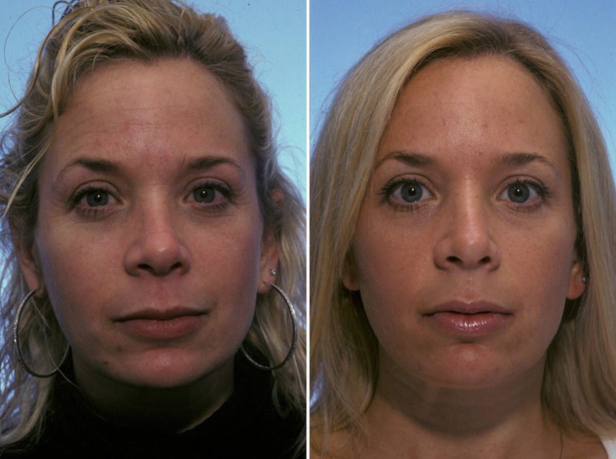 BOTOX® Before & After Gallery - Patient 409841 - Image 1