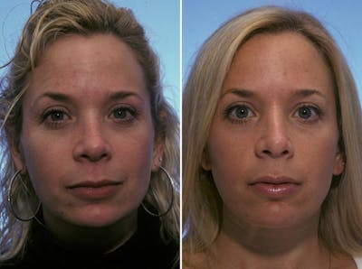 BOTOX® Before & After Gallery - Patient 409841 - Image 1