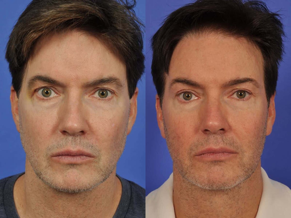 BOTOX® Before & After Gallery - Patient 320555 - Image 1