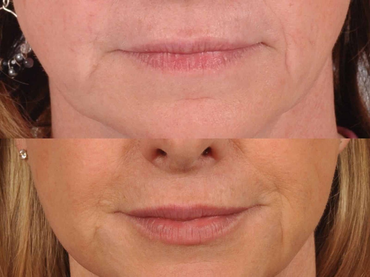 Fillers Before & After Gallery - Patient 141037 - Image 1
