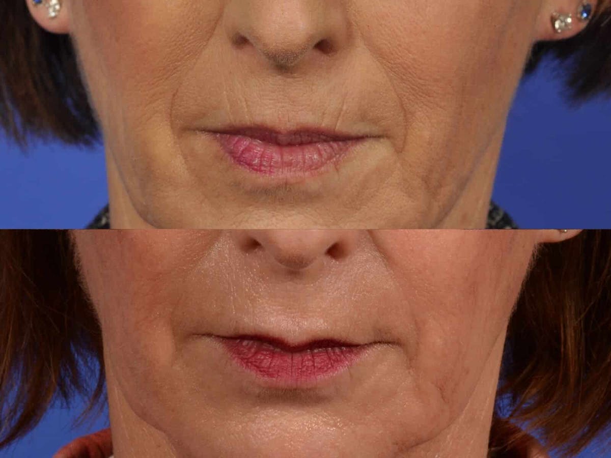 Fillers Before & After Gallery - Patient 122180 - Image 1