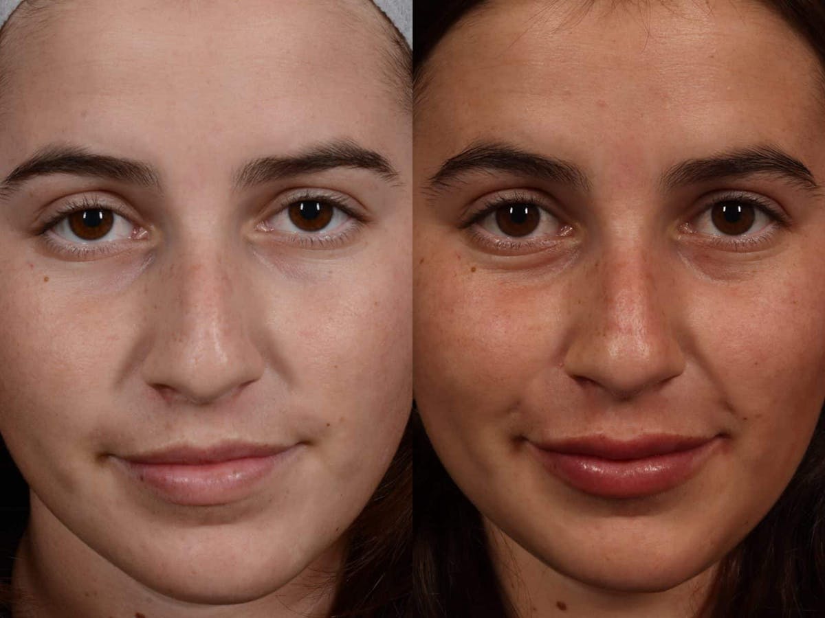 Fillers Before & After Gallery - Patient 244429 - Image 1