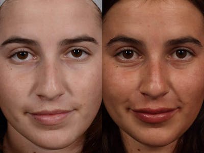 Fillers Before & After Gallery - Patient 244429 - Image 1