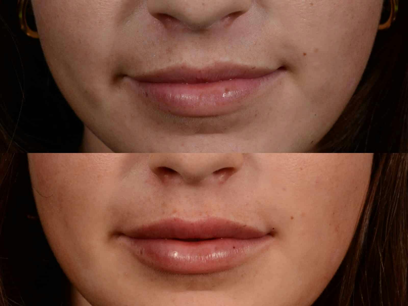 Fillers Before & After Gallery - Patient 244429 - Image 2